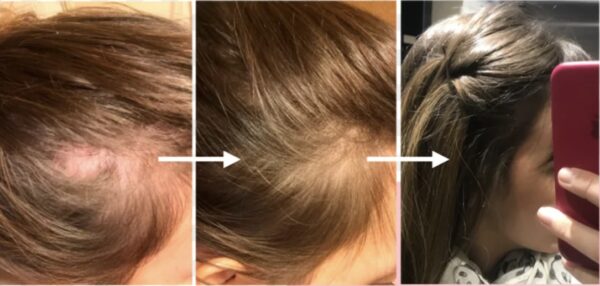 PACK DOBLE AMPOLLAS D´SHILA (FRENA LA CAIDA Y ESTIMULA EL CRECIMIENTO DEL CABELLO) - Imagen 3